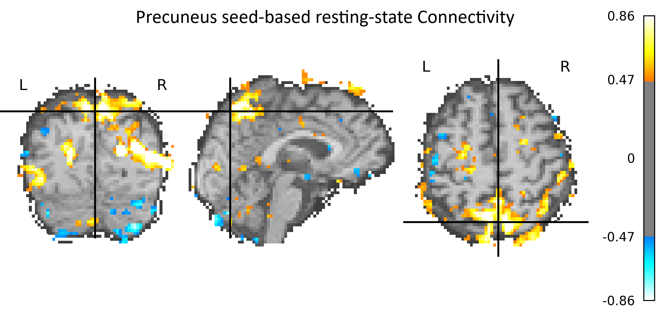 Precuneus seed-based resting-state connectivity map